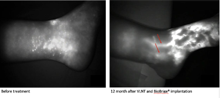 Lymphatic imaging before and after treatment